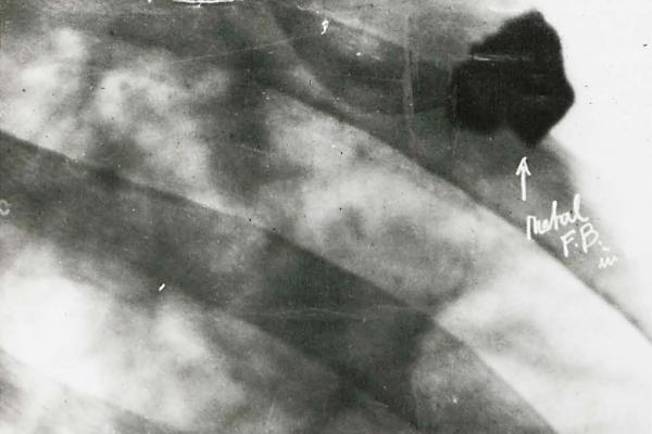 Shrapnel in lung x-rays on page 74